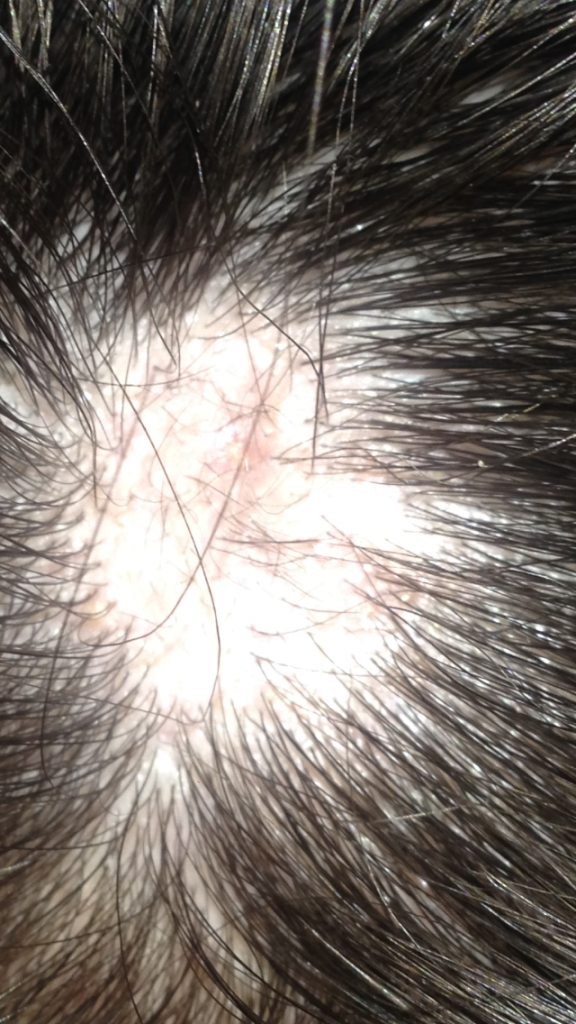 Bald Spot On Head After Popping Ingrown Hair Is It Alopecia